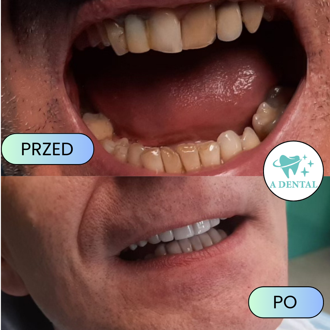 Metamorfoza uśmiechu przed i po leczeniu protetycznym w A Dental