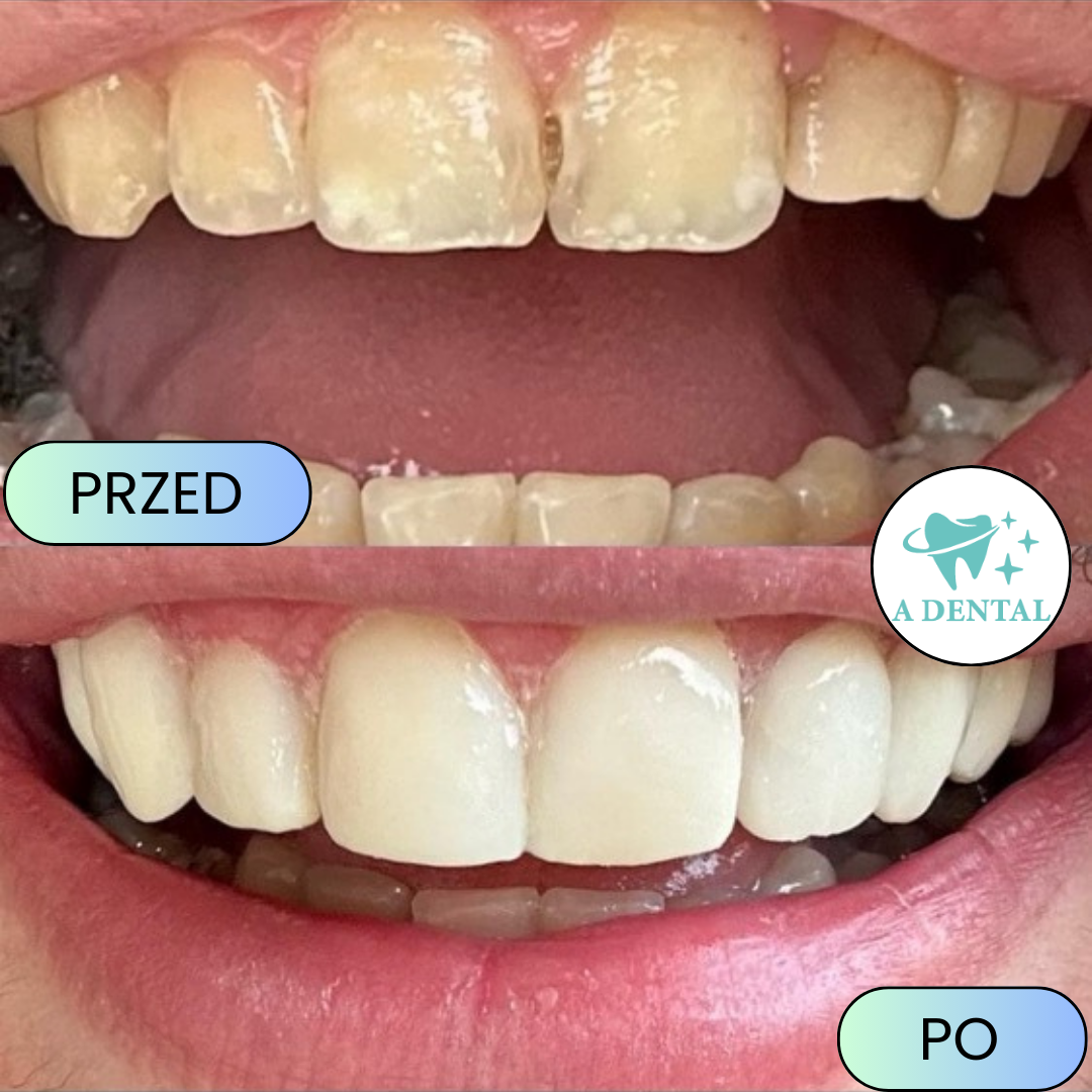 Wybielony i wyrównany uśmiech, metryczka przed i po z A Dental
