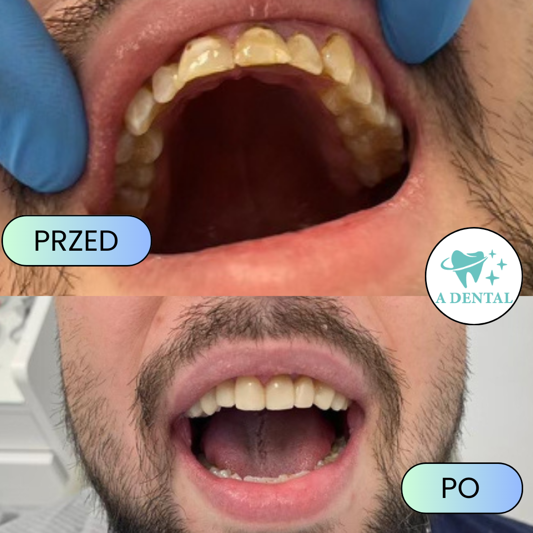 Odbudowa uśmiechu, zdjęcie przed i po leczeniu w A Dental