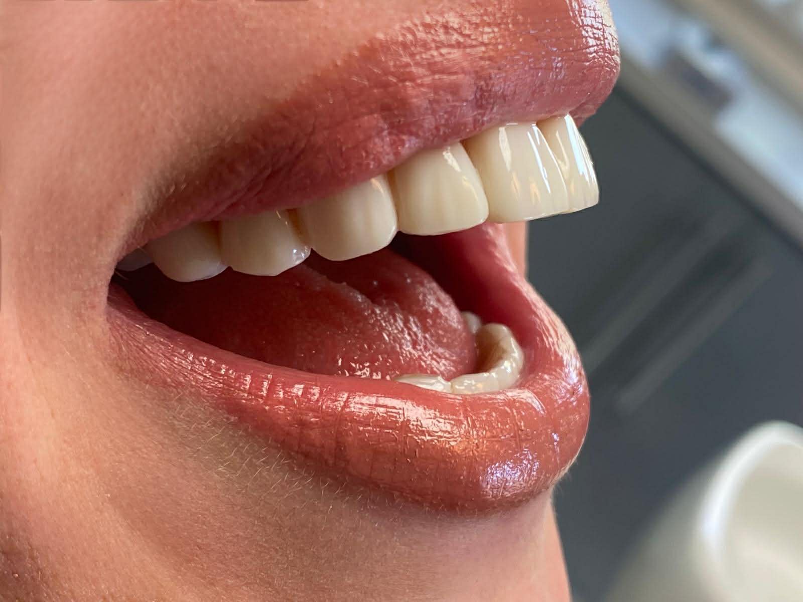 Naturalny uśmiech pacjentki po leczeniu w A Dental