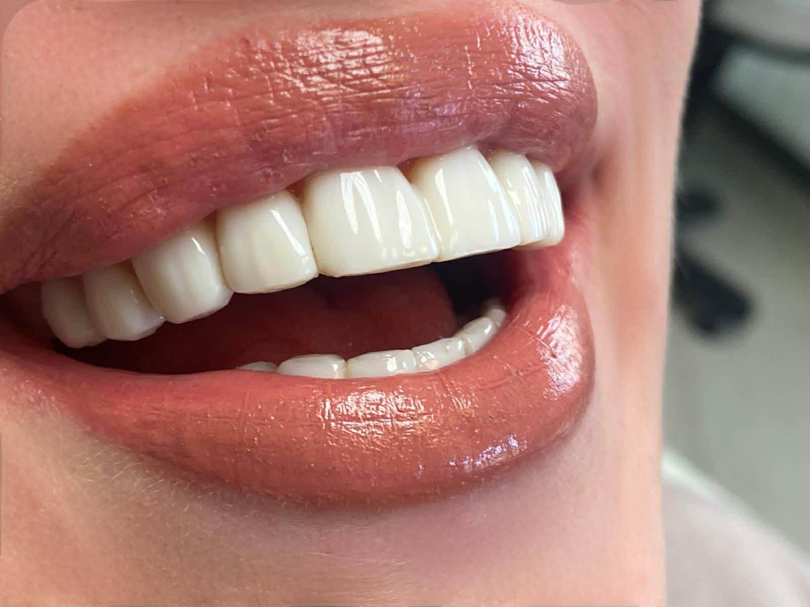 Jasne, zadbane zęby po leczeniu w gabinecie A Dental