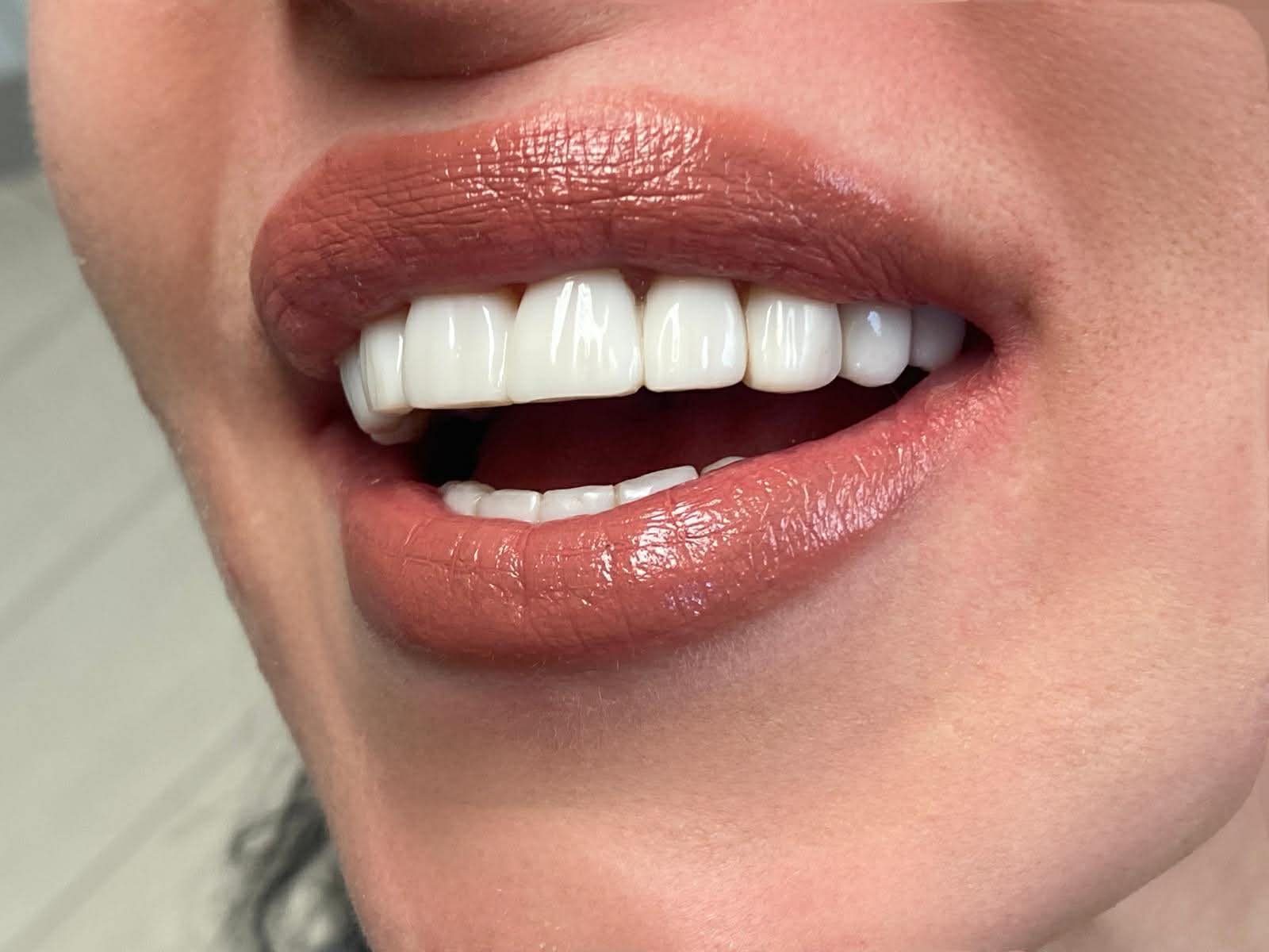 Naturalny uśmiech po pracy estetycznej w A Dental